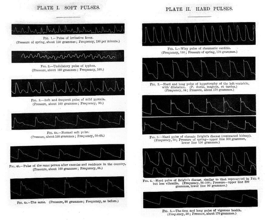A photograph from a medical text book showing the Pulse tracings in health and disease. The tracings are shown as thin white waves on a black rectangle background. 