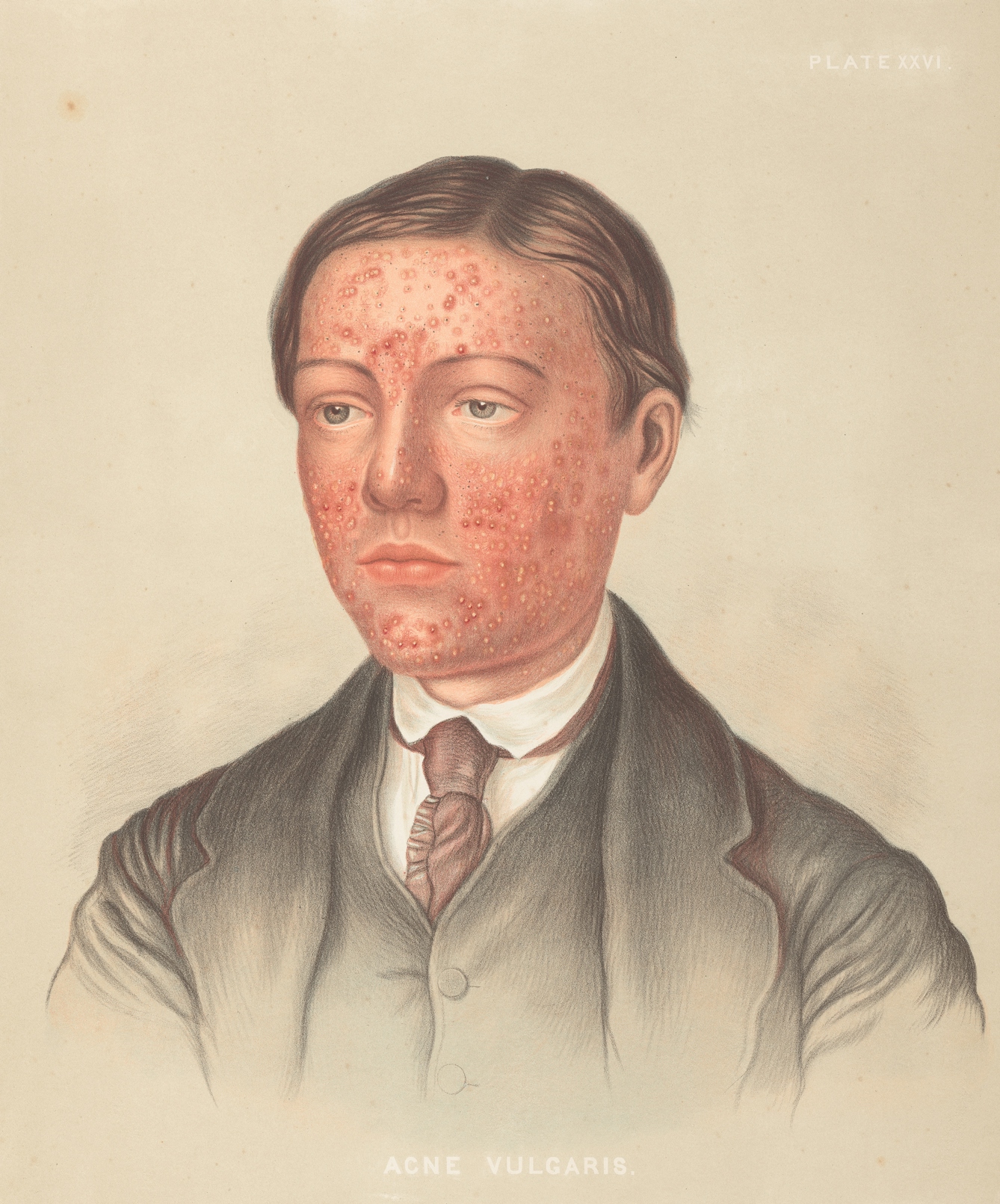 Photograph of an illustration showing the head and shoulders of a man in a suit and tie, with red acne marks on his face.
