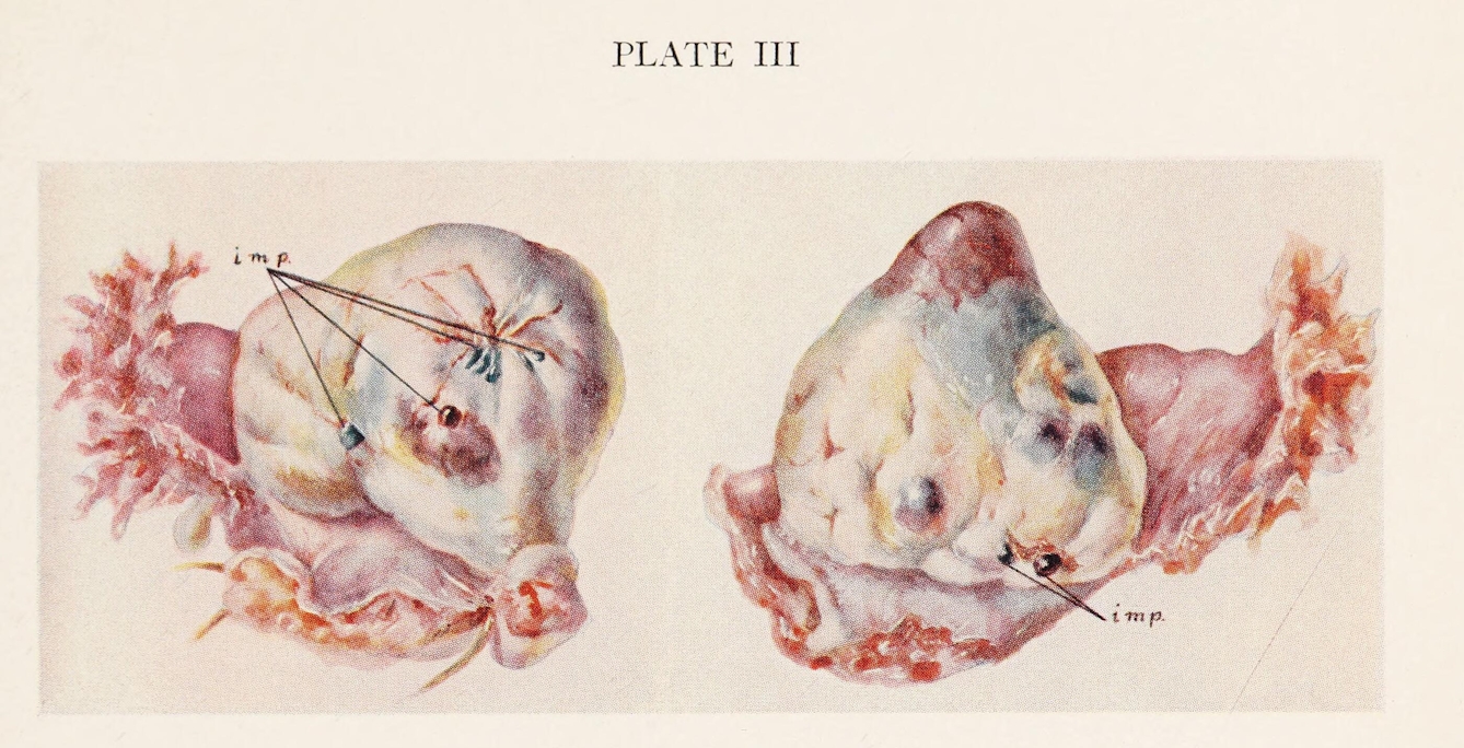 A colour illustration showing two ovaries. On the both right and left, there are endometrial implants and on the left there is also an area of dark colour from hemorrhage (presumed to be menstrual).