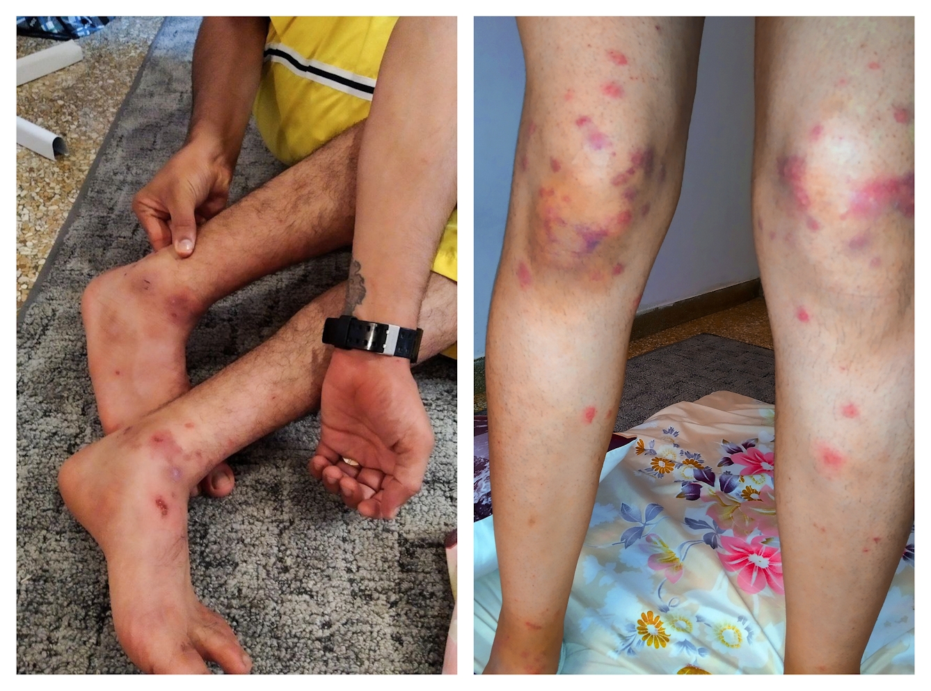 Photographic diptych showing on the left a man's legs and on the right a woman's legs. Both images show injury to the legs in the form of cuts, bruises and swellings.
