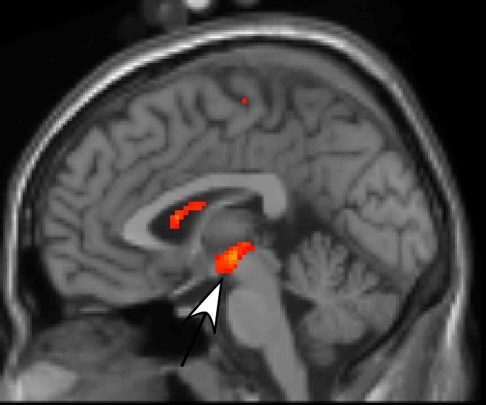 Side view of a brain scan showing areas in the middle and one in the upper middle marked with red to indicate activity.