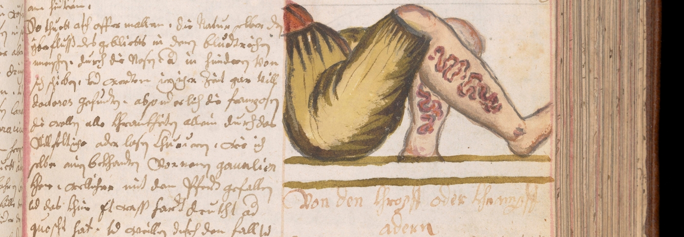Painted image beside some handwritten text showing two legs wearing green breeches that finish at the knees. One leg is slightly raised, and both are covered in leeches below the knee.