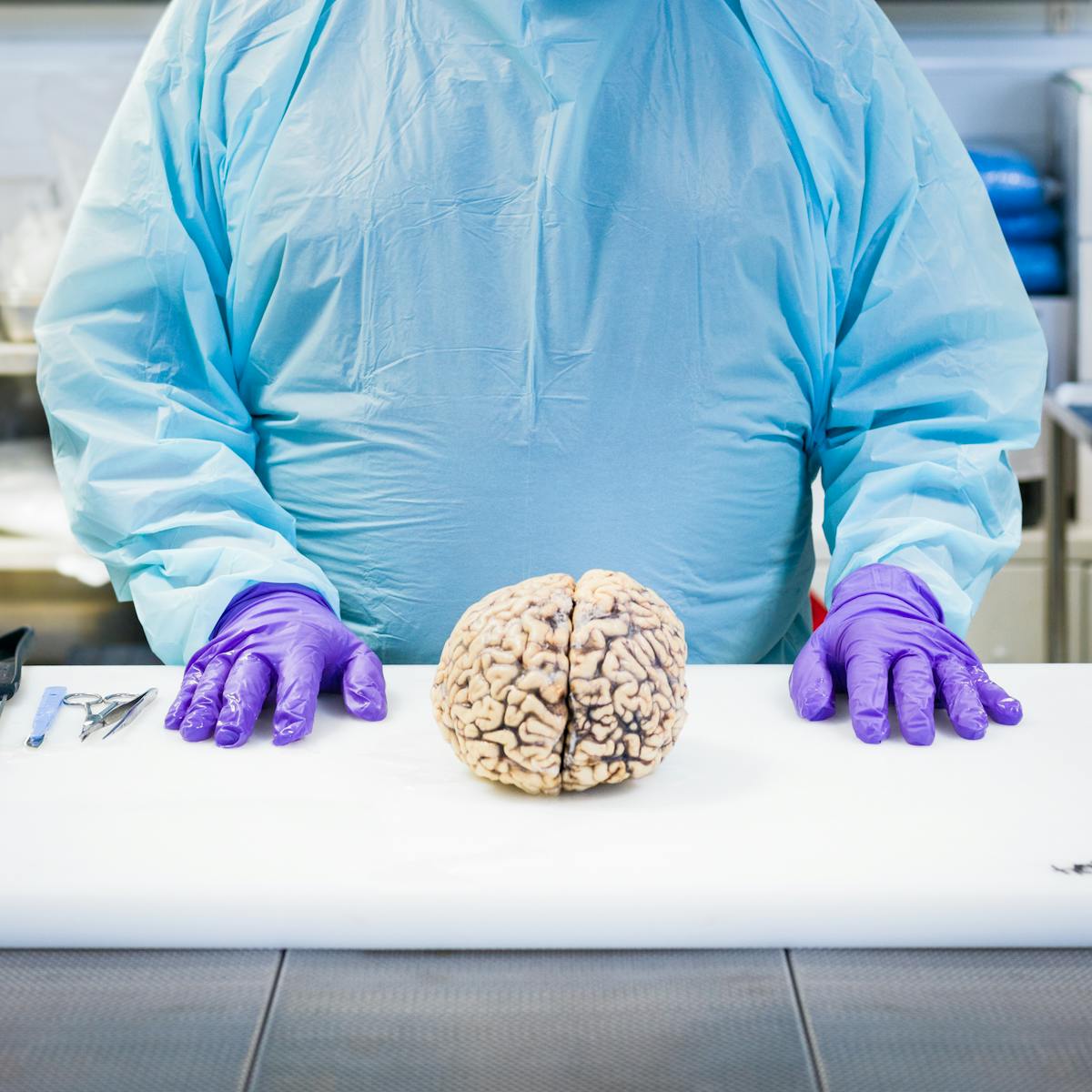 Photograph of a Neuropathologist stood at a dissection table, purple gloved hands resting palms down on a white chopping board. Between their hands is a donated human brain awaiting dissection. 