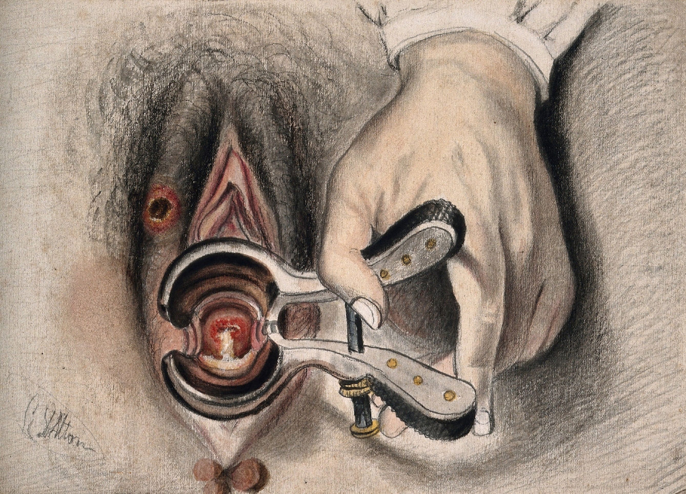 A pencil and gum arabic, with watercolour drawing of an infected sore on the female genitalia. The vagina is held open by a vaginal speculum held by a large hand. 