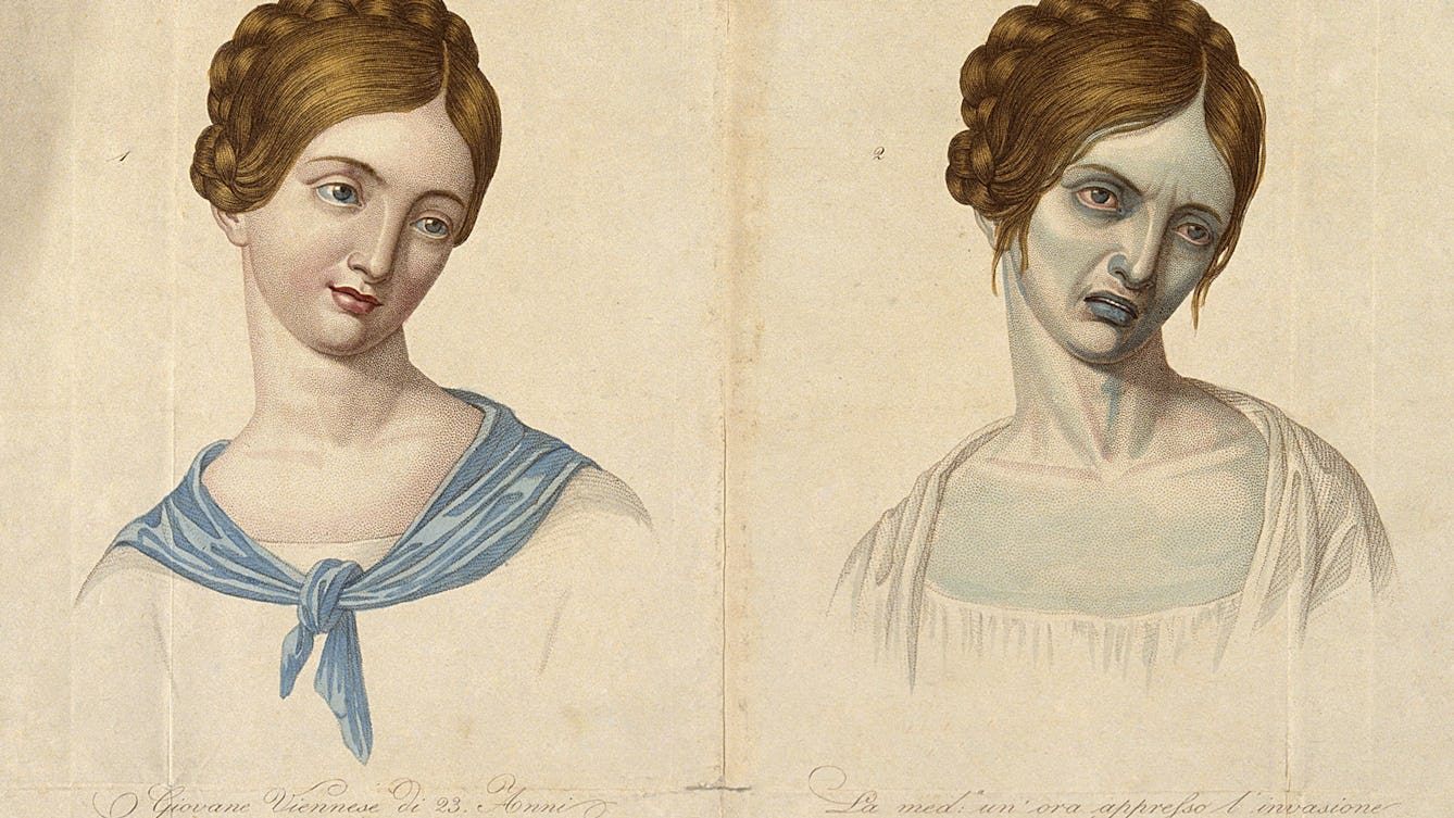 A young Viennese woman, aged 23, depicted before and after contracting cholera