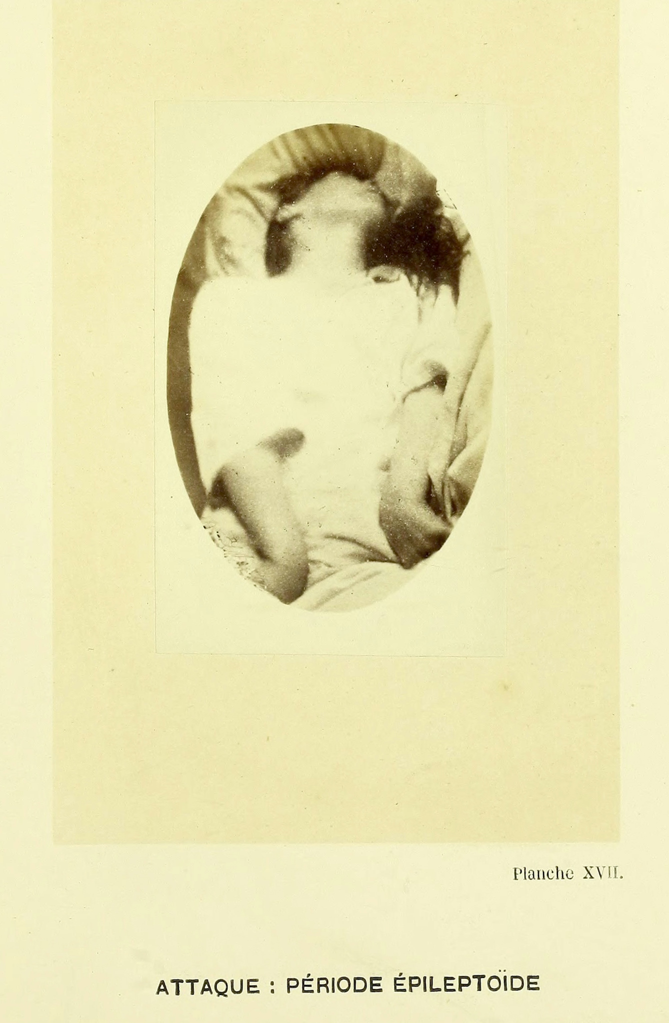 Photograph of a woman having an epileptic seizure at Saltpetriere Hospital