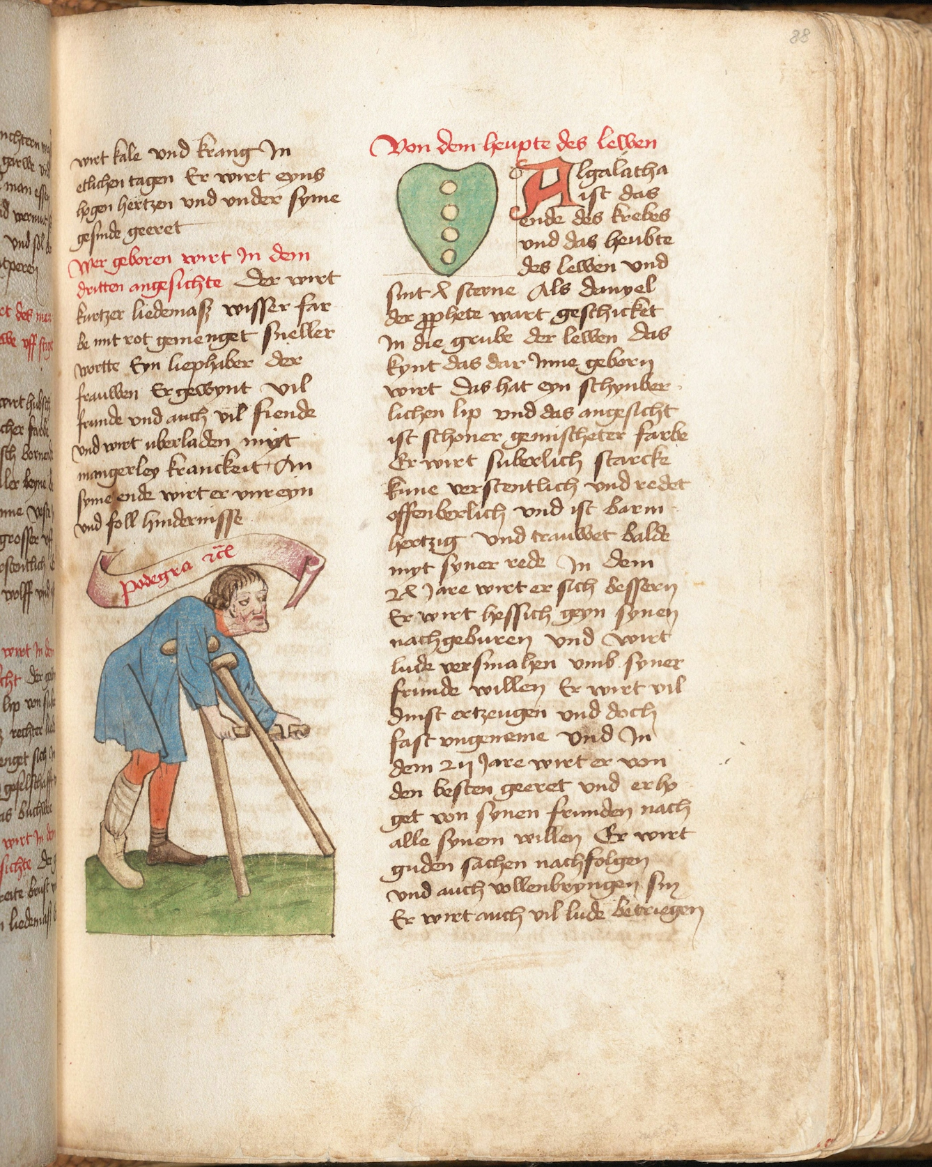 A page from a 15th century manuscript with two columns of gothic text and an illustration in the left column of a man leaning forward as he uses a pair of crutches with shoulder supports and handles further down the length of the crutches.