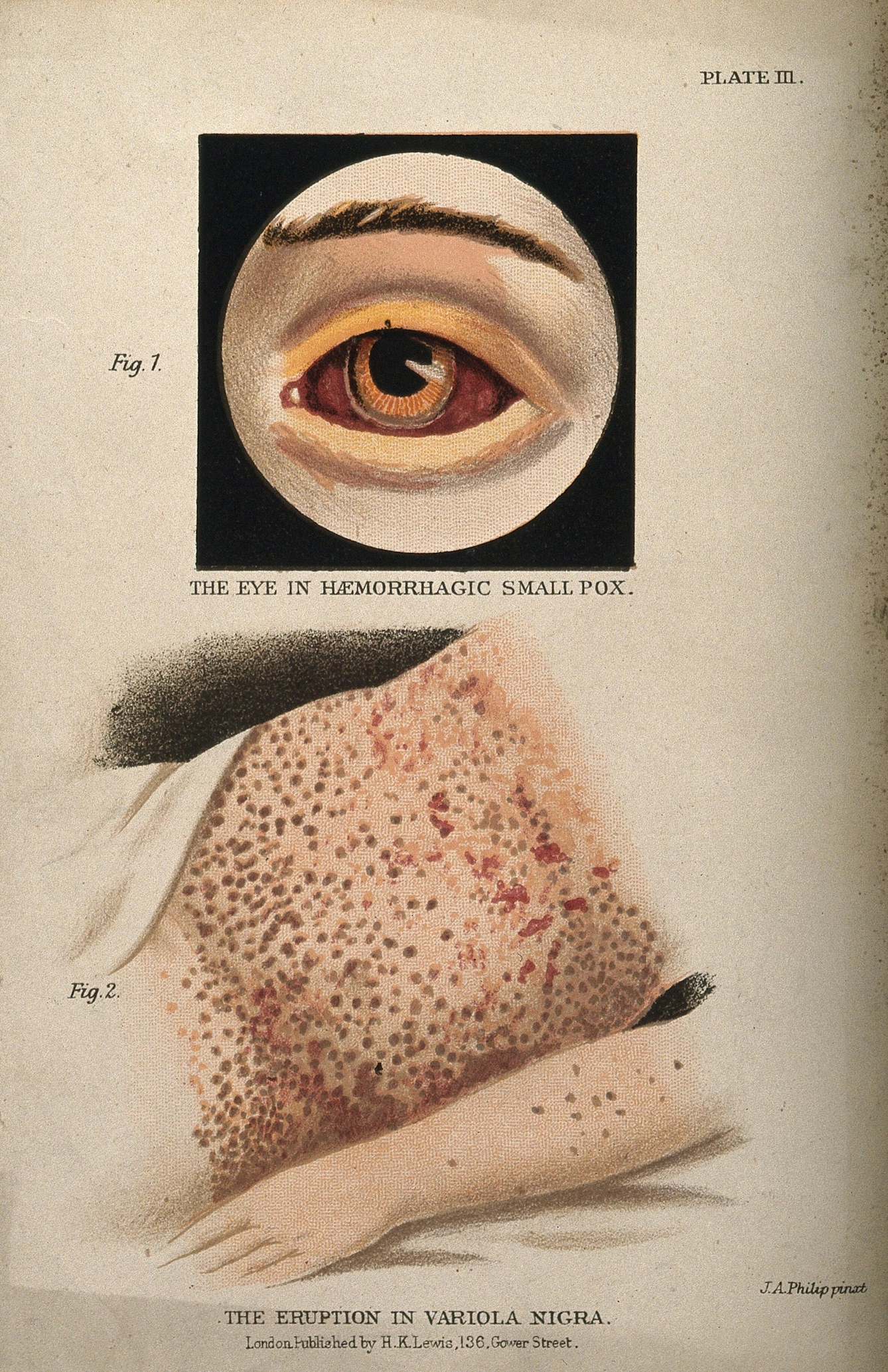 A colour illustration featuring two images. The top image shows a bloodshot eye against a black background. The bottom image shows the stomach and arm of a person; the skin is covered in dark red spots.