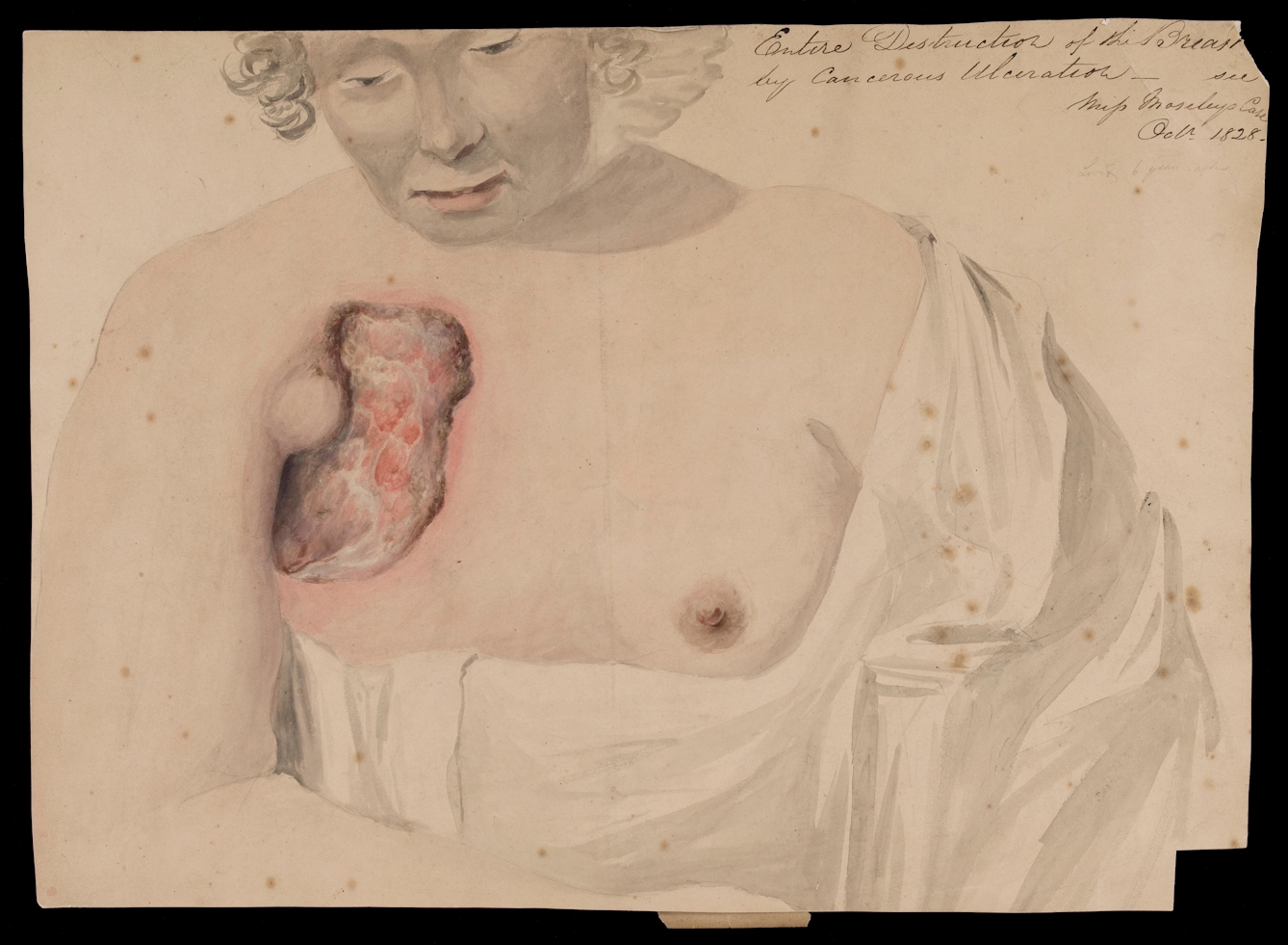 Watercolour of a woman looking downwards - her upper body is exposed showing her right breast destroyed by cancer