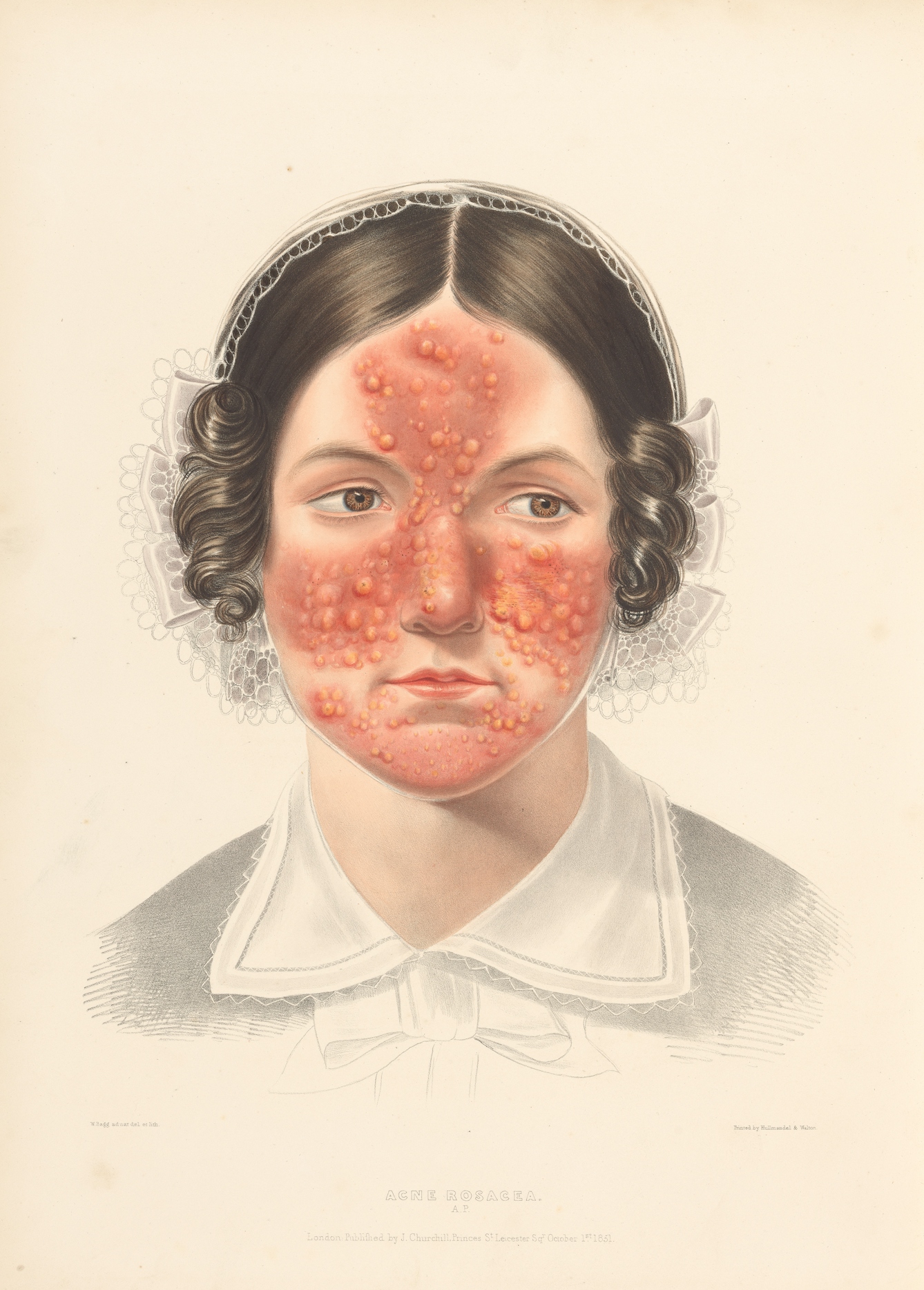 Photograph of an illustration showing the head and shoulders of a woman in a bonnet with red acne marks on her face.
