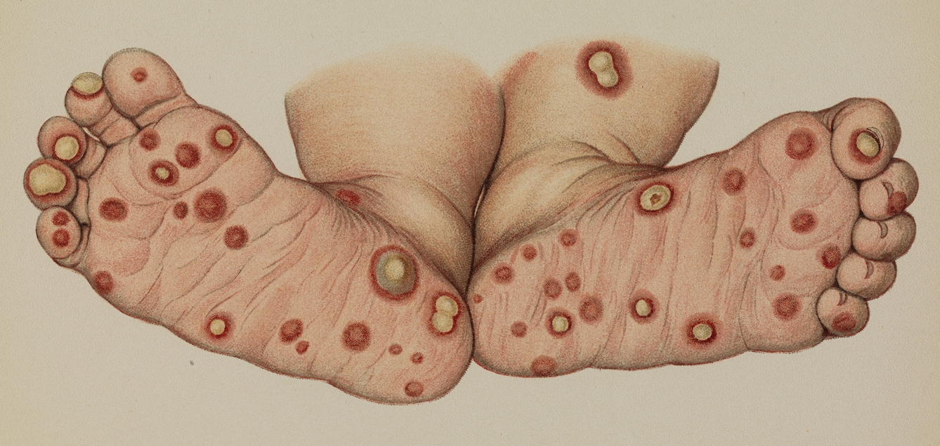 The feet of a six-day-old baby with congenital syphilis.