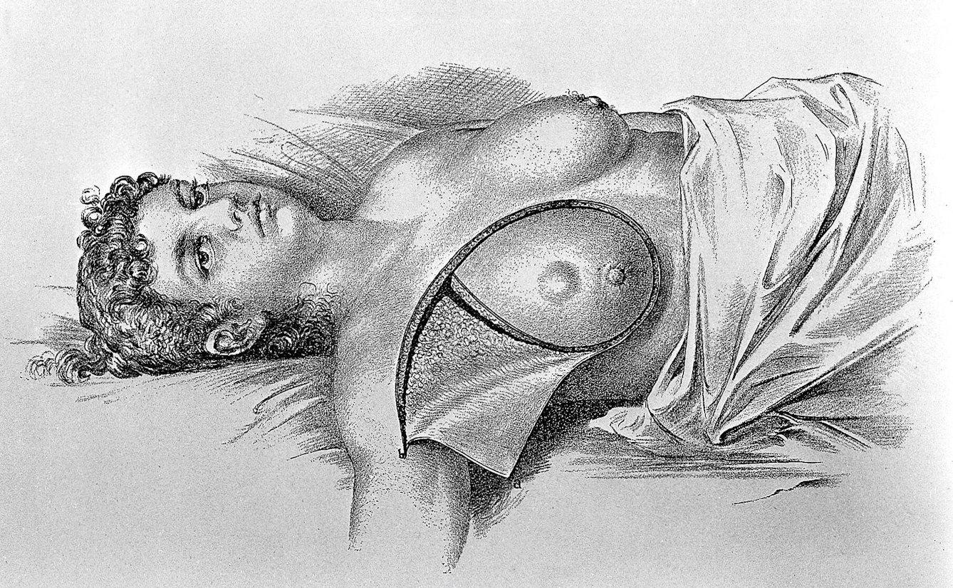 An illustration of a woman undergoing a radical mastectomy - the surgical removal of her right breast