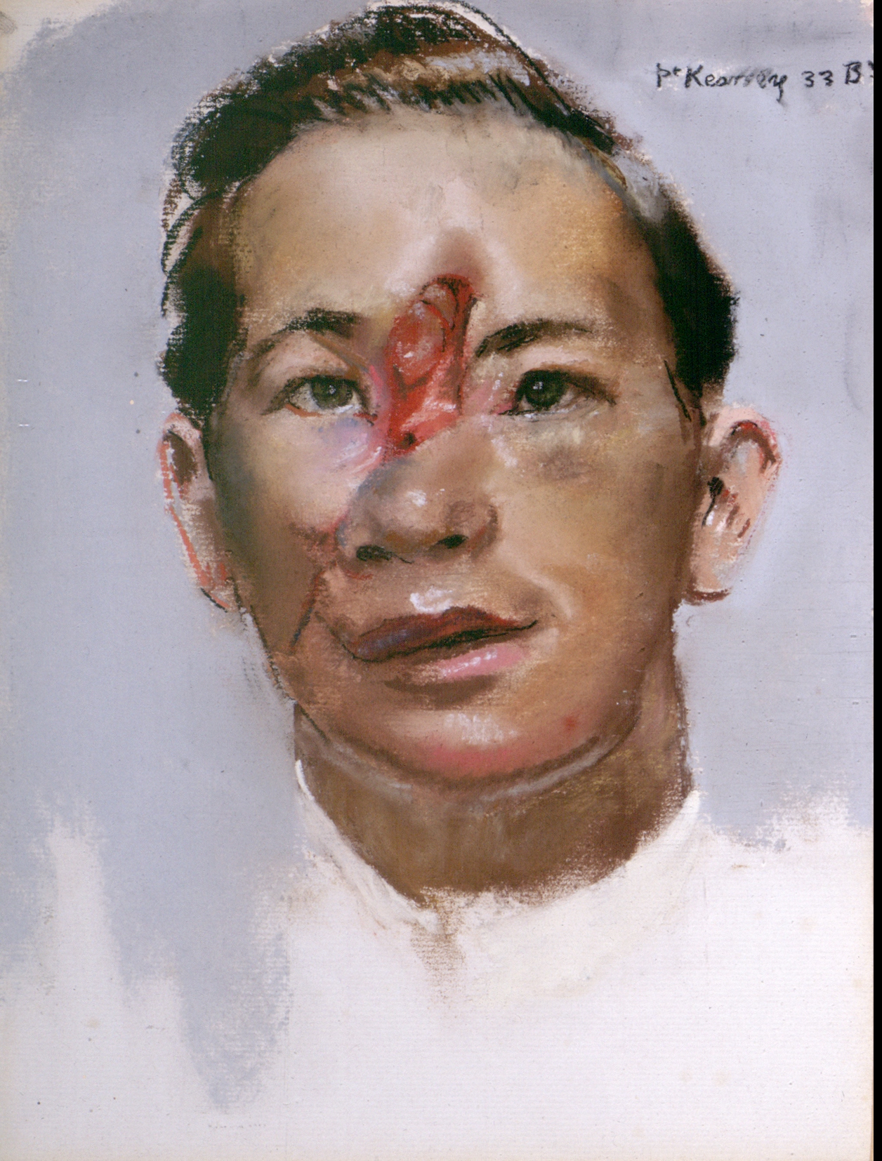 Watercolour painting of a man's face with a large injury between the eyes and across the right cheek.
