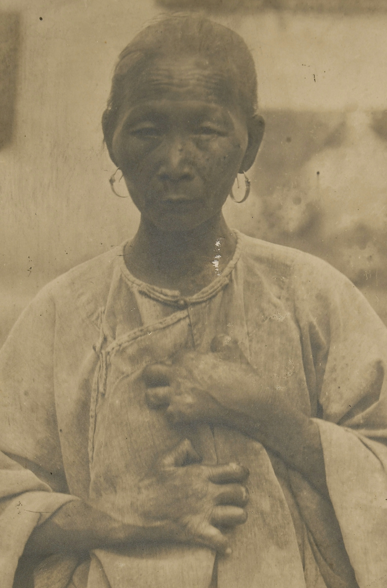 A Chinese woman suffering from leprosy