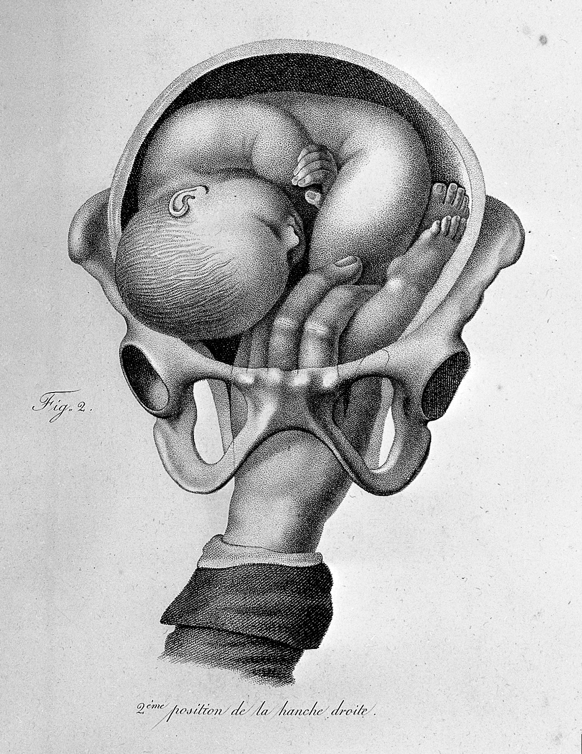 Figure showing child being turned in the womb.
