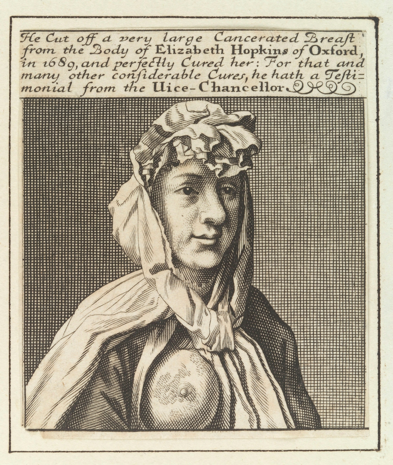 Engraving of a 1700s woman with breast cancer baring her right breast