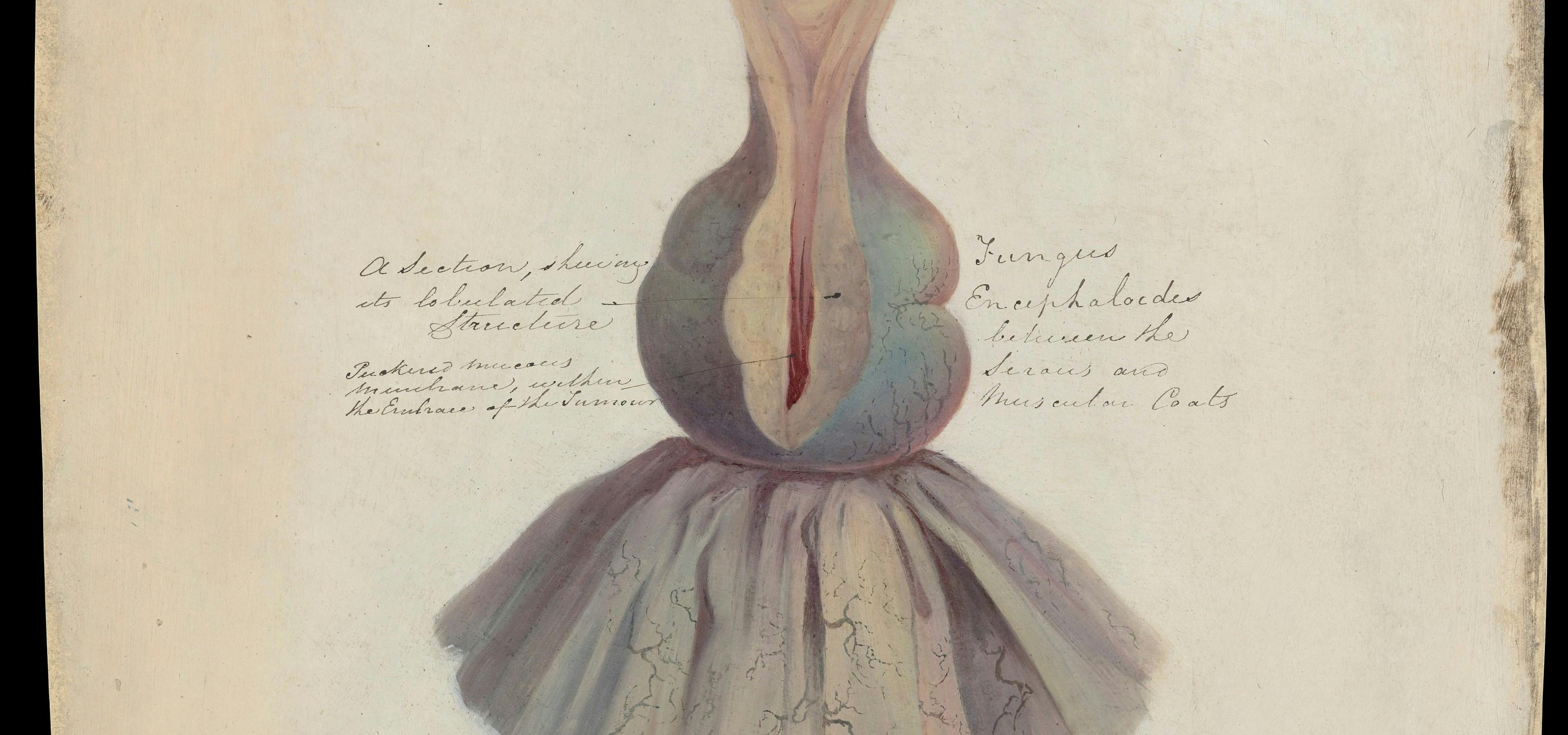 Medical effects of corset wearing. 1881 illustration showing how