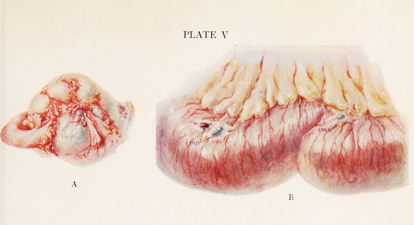 Illustration of an ovary on the left and part of the ileum on the right, both of which have endometrial implants adhering to them and labelled with arrows and the word "imp."