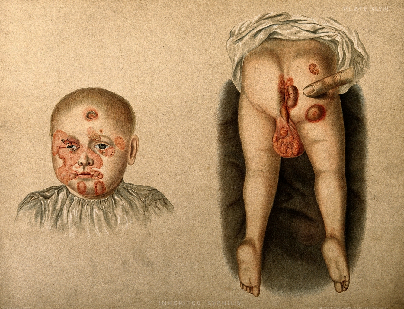 A baby boy with congenital syphilis.