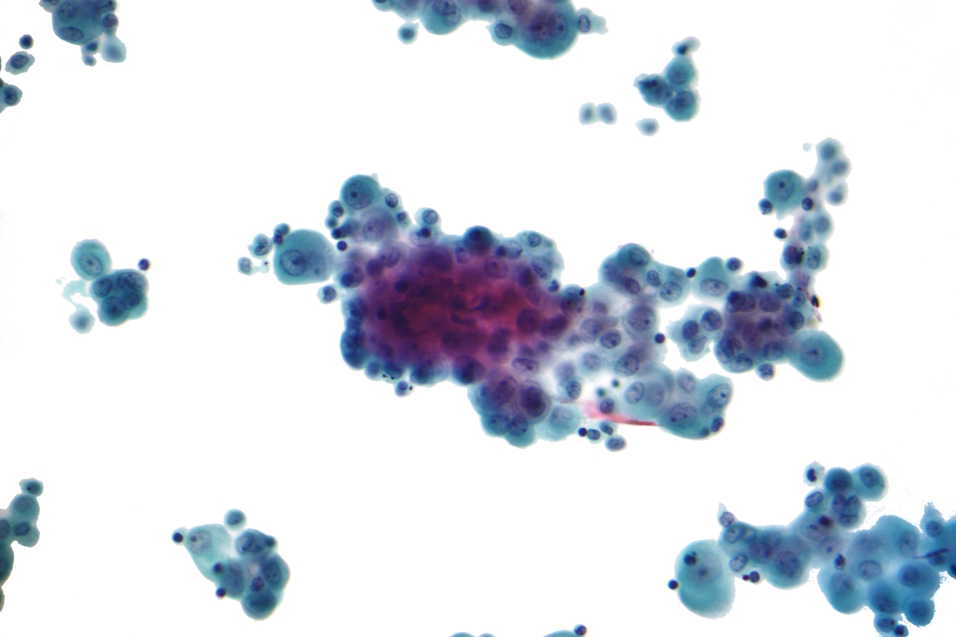 Colour image of cells showing irregularities and clusters of cells that indicate mesothelioma, a type of cancer often caused by asbestos.