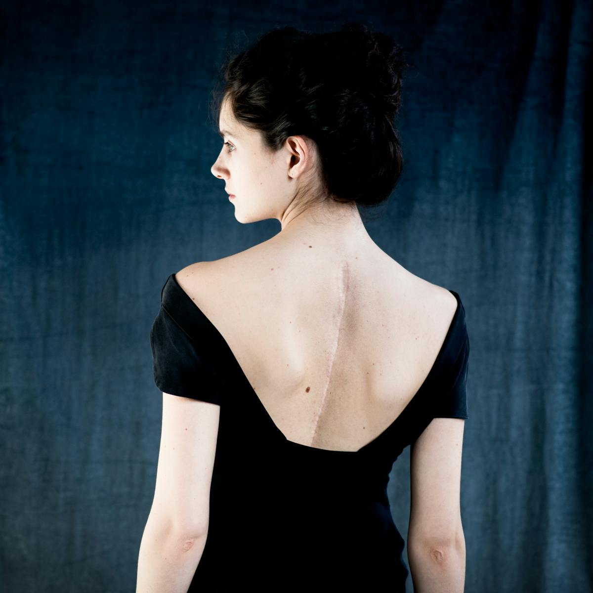 Photograph of a young woman from behind, from the waist up. Her head is turned to the left revealing her profile. She is wearing a low cut black dress which reveals a long scar following her spine. In the background are drapes of blue and white fabrics.