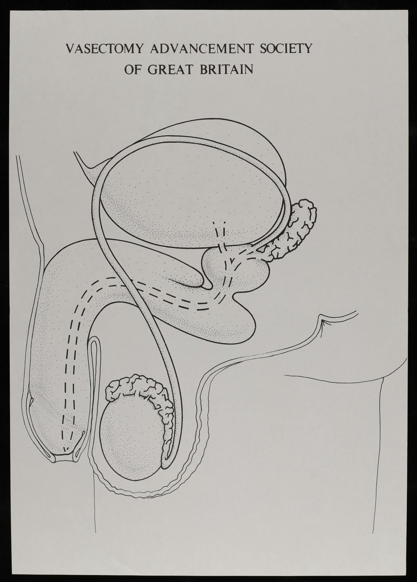 Line illustration of a vasectomy, titled "Vasectomy Advancement Society of Great Britain", 1972-1973
