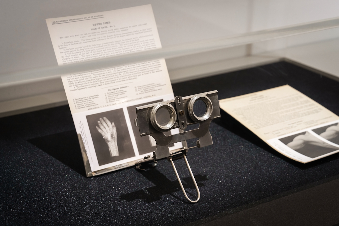 Photograph of a gallery exhibition display case containing archive material and an old stereoscopic viewer made up of metal brackets and lenses. The archive material  is made up of 2 sheets of card containing typed text and pairs of anatomical stereo photographs of a hand and a bicep.