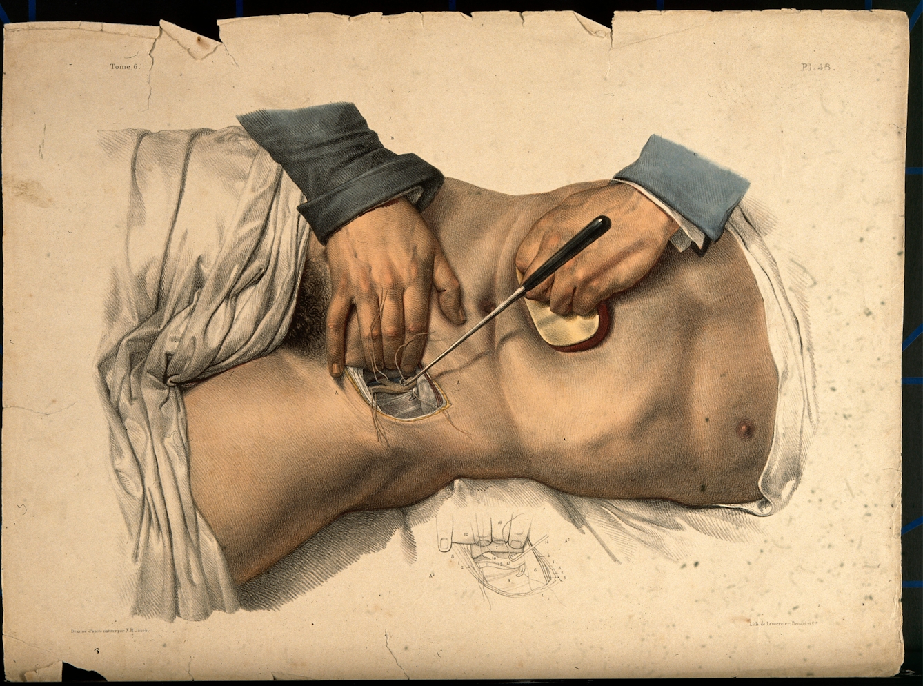 Coloured lithograph showing an operation being performed on the lower abdomen of a male patient.