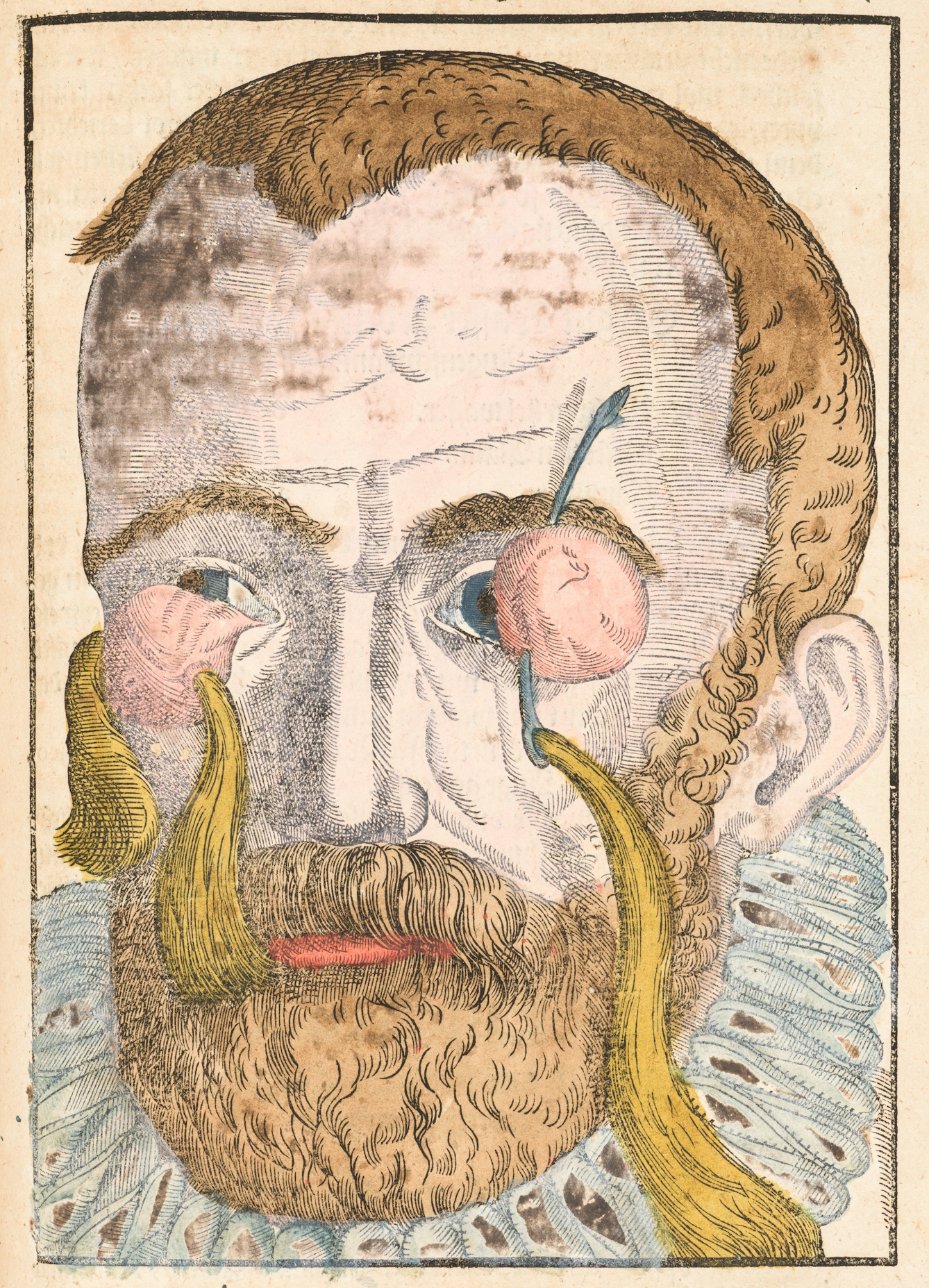 Coloured engraving from a 16th century book showing a man's head and the ruff of his clothes. His eyes are partially covered by two pink shapes, one of which has strands of hair running through the centre, the other has a needle running through the middle which is attached to stands of hair.