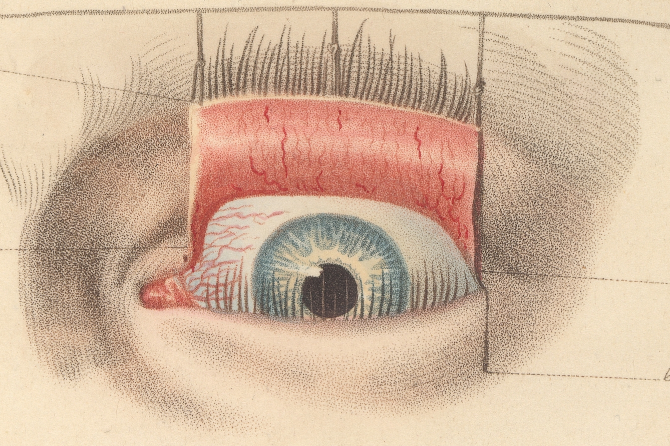 Close up of an engraving of eye surgery showing how tiny stipple dots are used to create colour and tone.