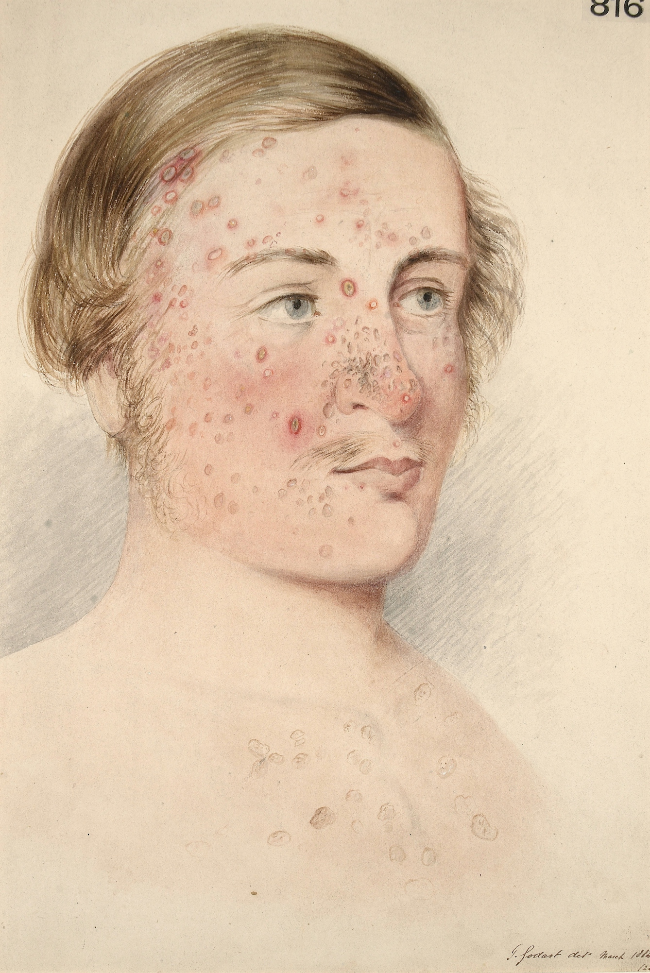 Photograph of an illustration showing the head and shoulders of a man, with red acne marks on his face, neck and chest.