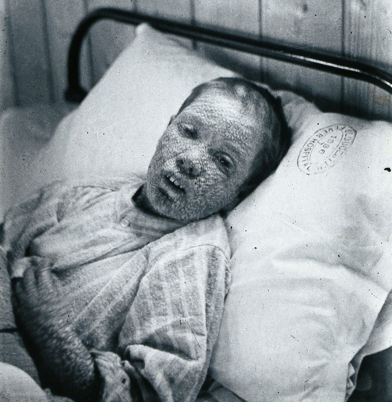 Gloucester smallpox epidemic, 1896: Ethel Cromwell, aged 14
