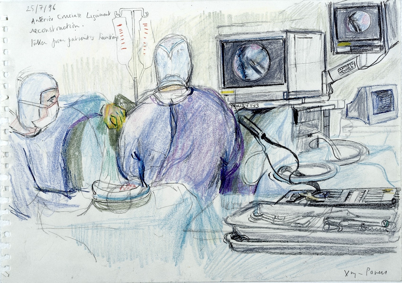 A colour sketch of an operation showing the back and side of two people wearing scrubs, gloves and masks, with the view on several monitors of the keyhole view inside the patient.
