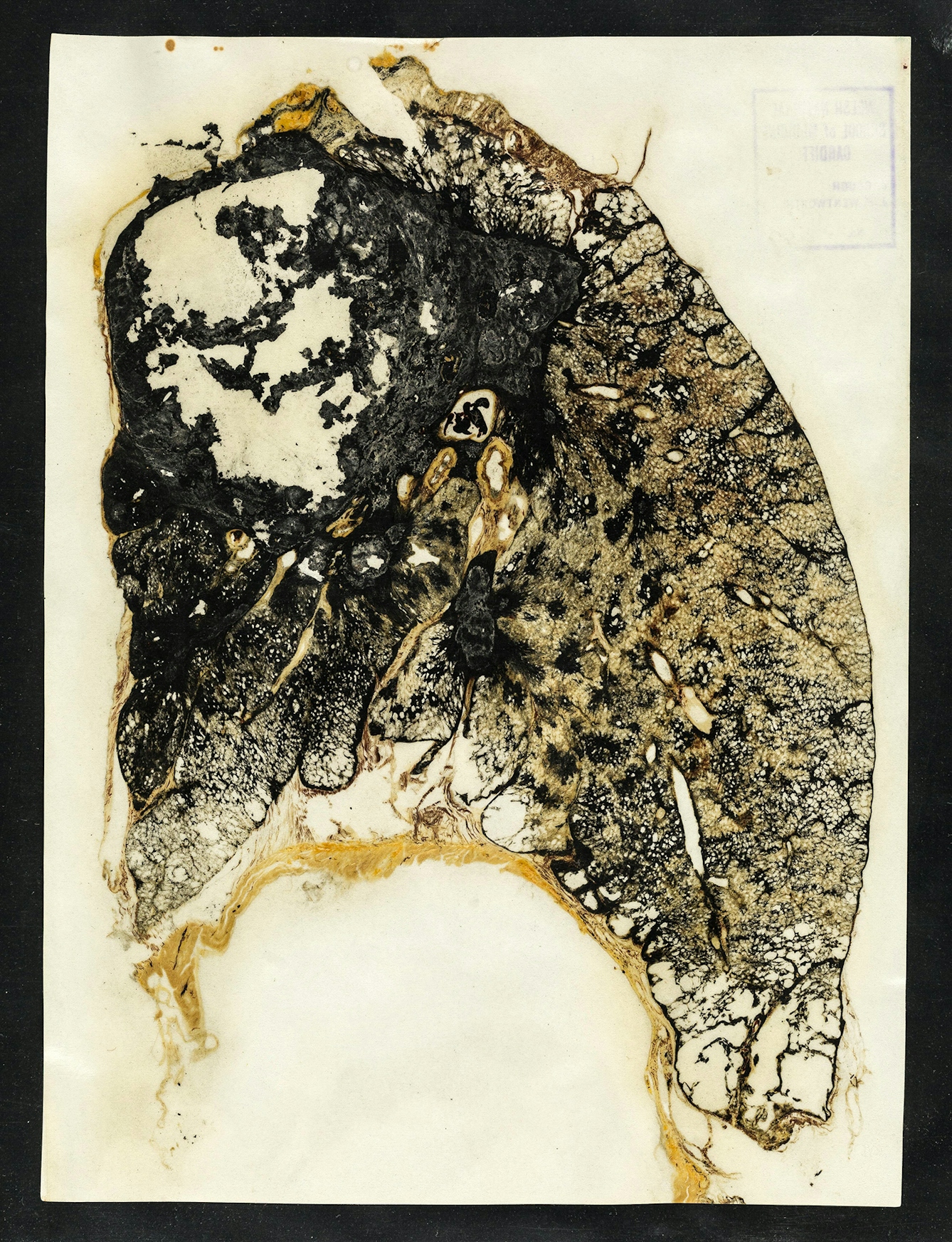 Detailed illustration of a lung with pneumoconiosis