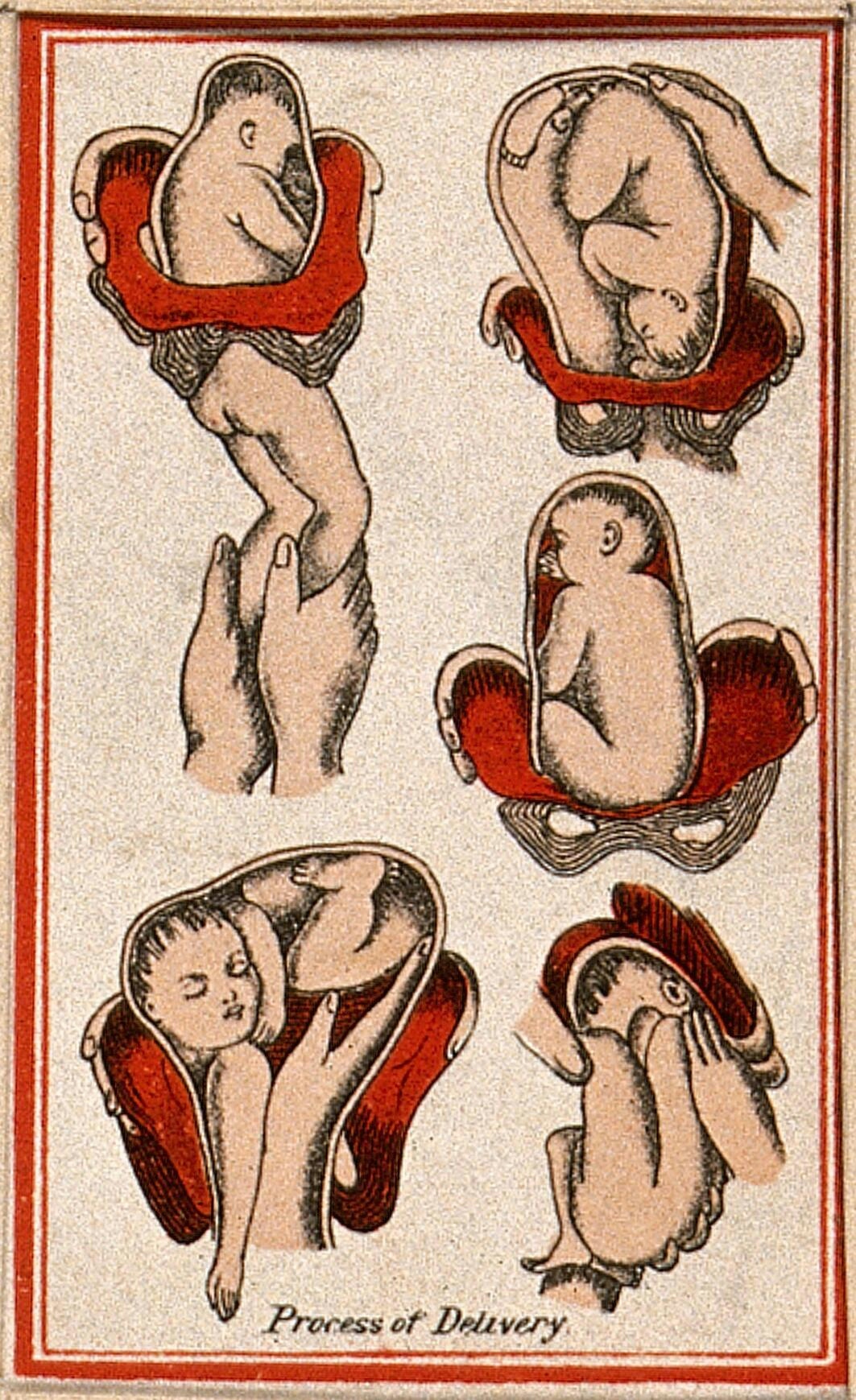 Colour lithograph showing five different stages of a baby being delivered out of the womb. A small line of text at the bottom reads 'Process of delivery'. In four of the five lithographs a hand or hands are assisting with the delivery of the baby, for example by guiding its legs. 