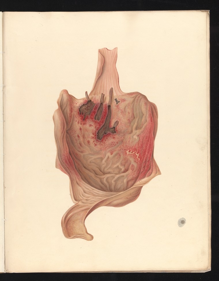 Coloured lithograph showing the stomach part of the oesophagus and duodenum of a young woman poisoned by arsenic.