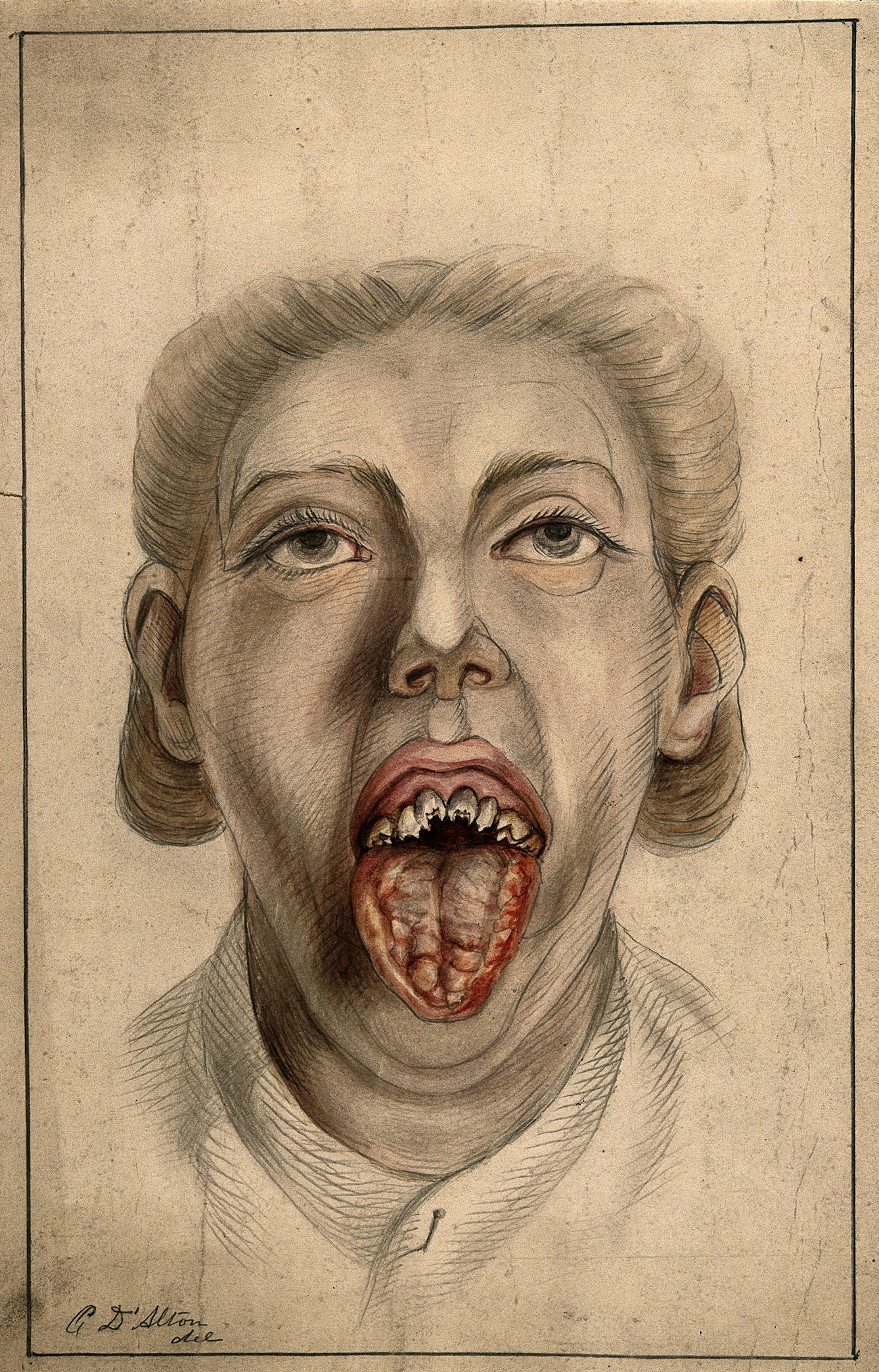 Woman with diseased tongue and broken teeth, 1874.
