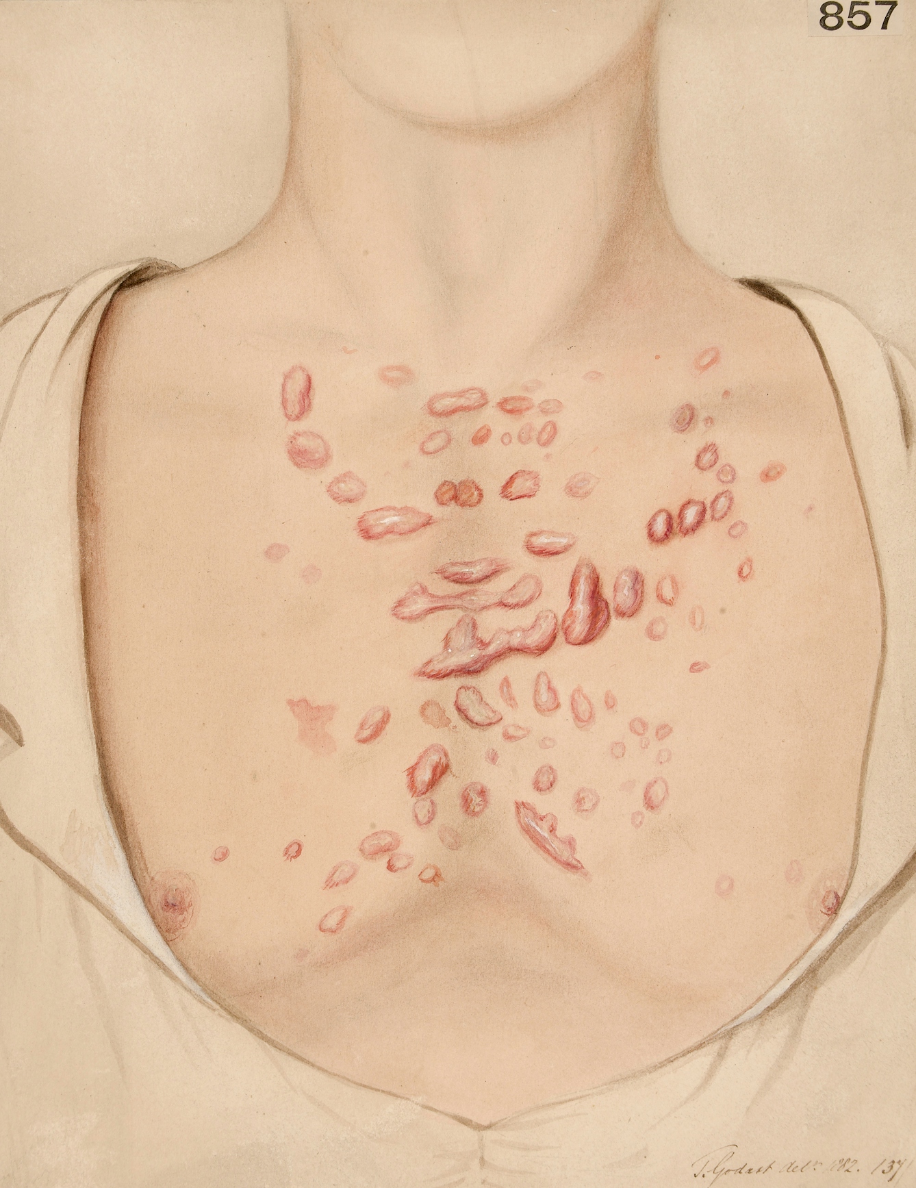 Photograph of an illustration of a man's chest showing red acne keloids.