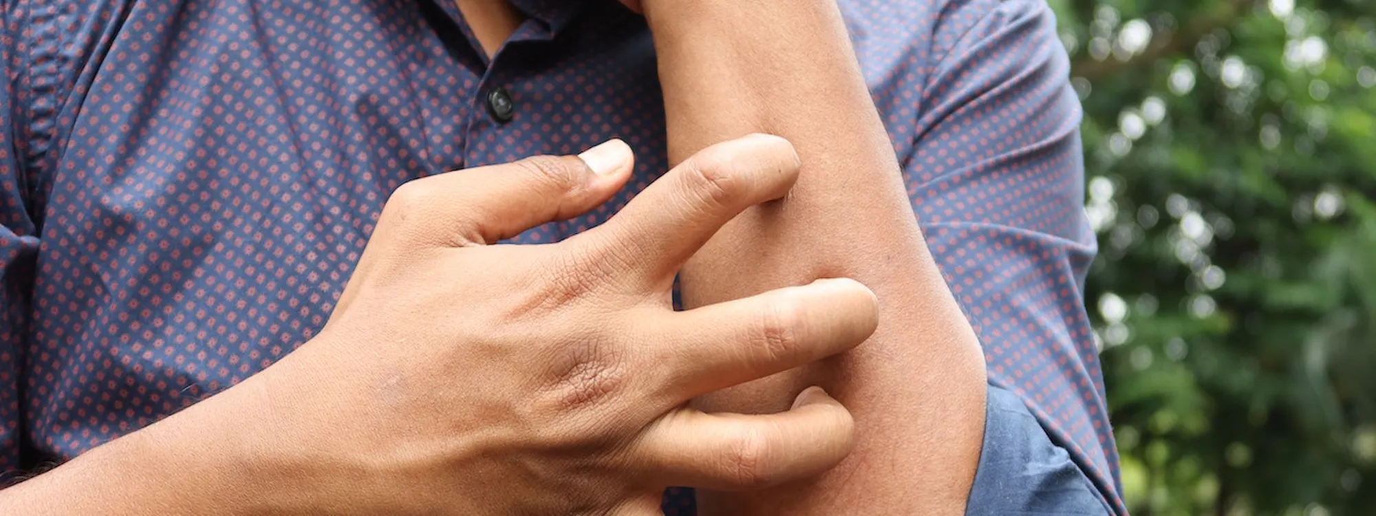 Urticaria - Was ist die Nesselsucht? Urticaria - Was ist die Nesselsucht?