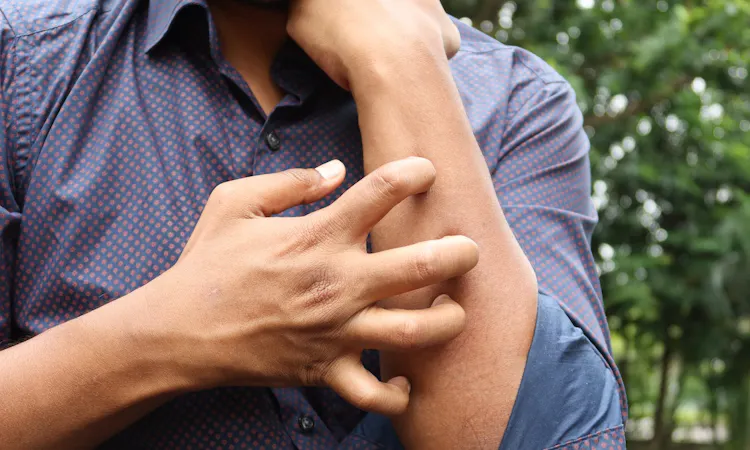 Urticaria - Was ist die Nesselsucht?