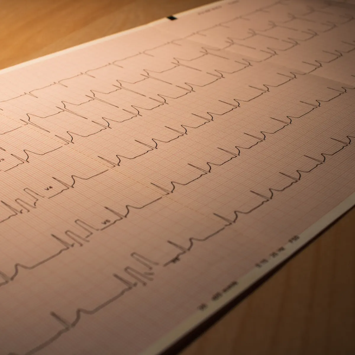 Diagnose von Herzrhythmusstörungen
