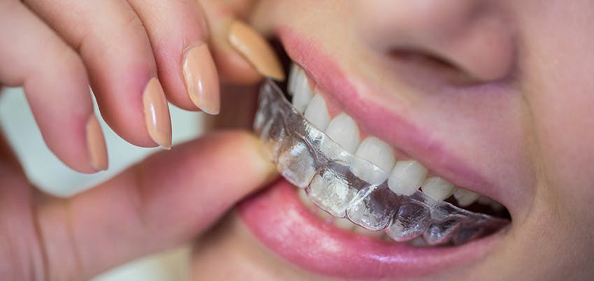 Invisible aligner price: is it a worthwhile investment?