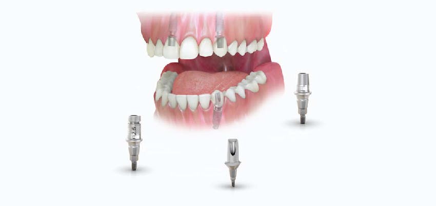I will get a dental implant, will it be painful?