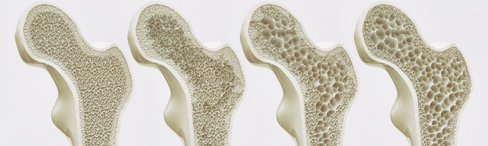 Osteoporose in den Wechseljahren