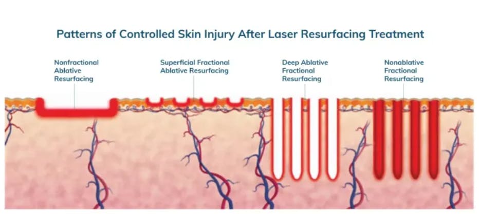 co2 laser treatments on skin
