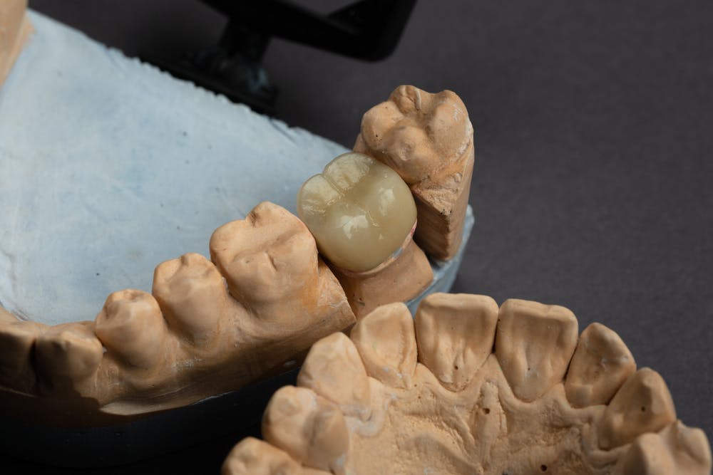 3d-printed dental prosthetics