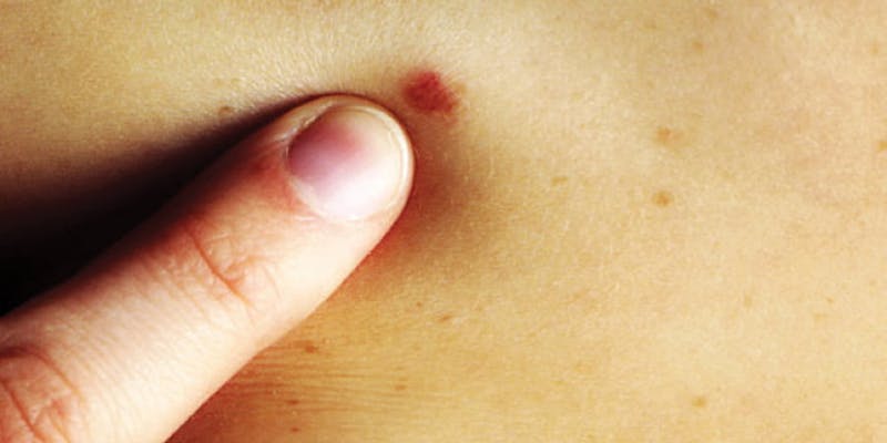 Чувајте се од сончевите зраци, рак на кожата е трет по број на случаи во земјава