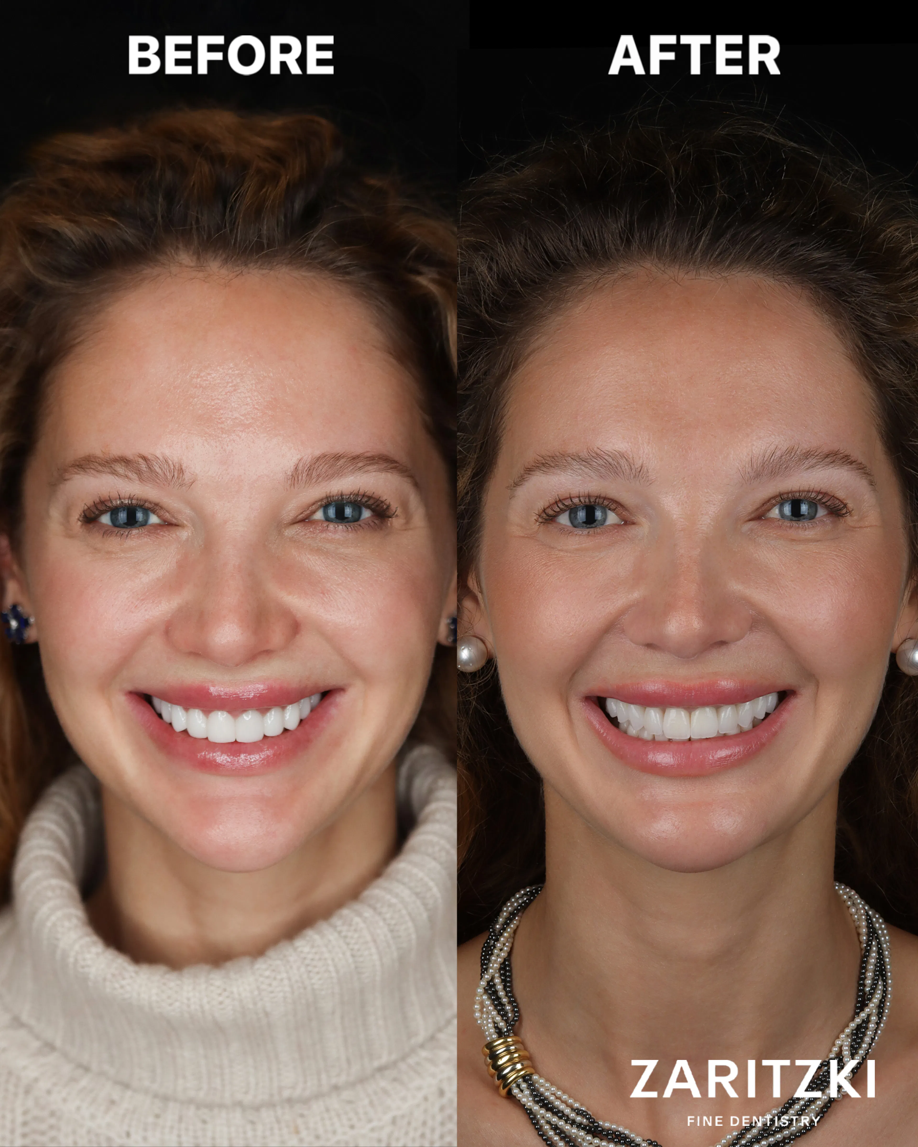 Veneer-Korrektur, vorher und nachher, Zaritzki Fine Dentistry, Berlin