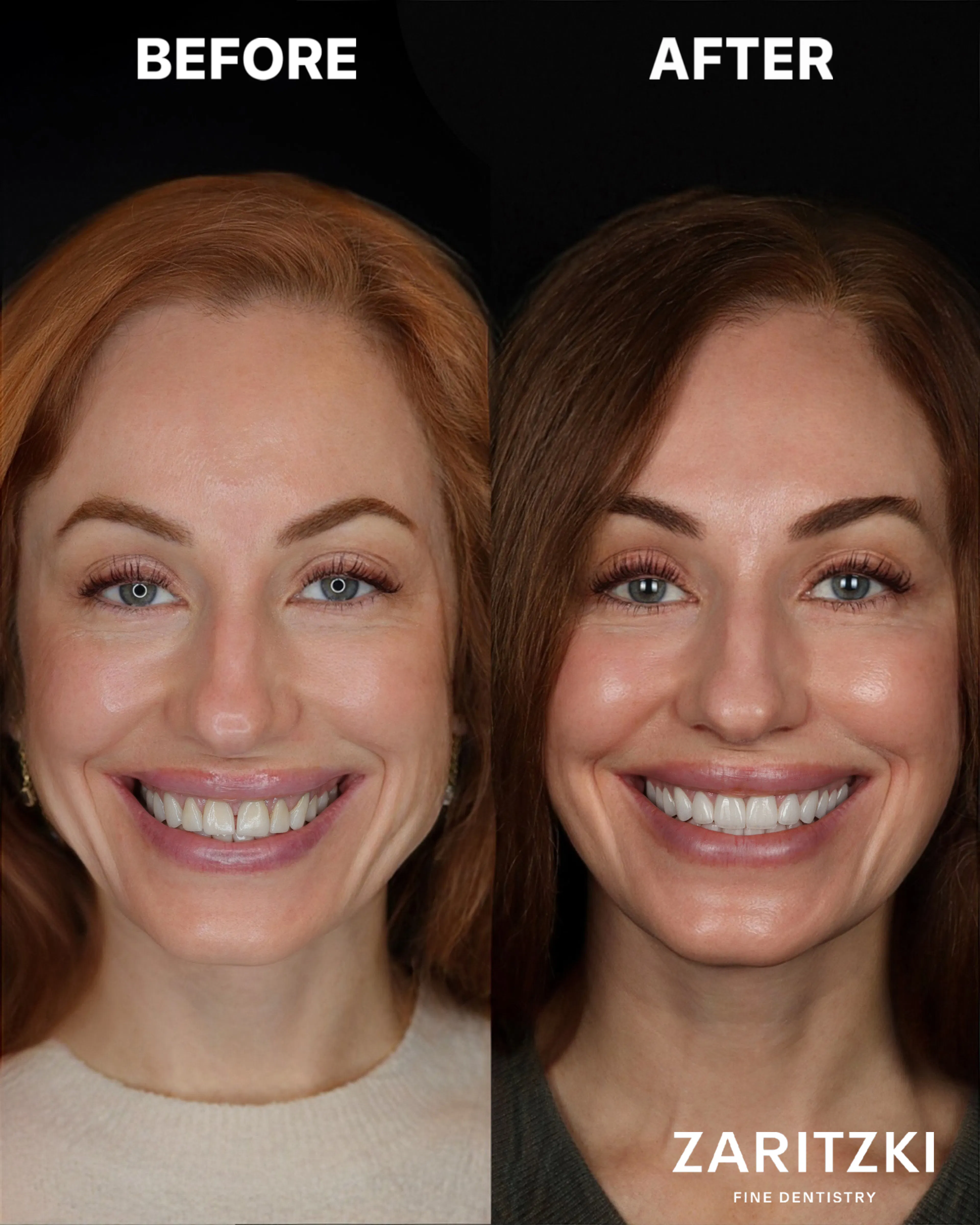 Zahnsanierung mit Kronen und Bissrekonstruktion, vorher und nachher, Zaritzki Fine Dentistry, Berlin
