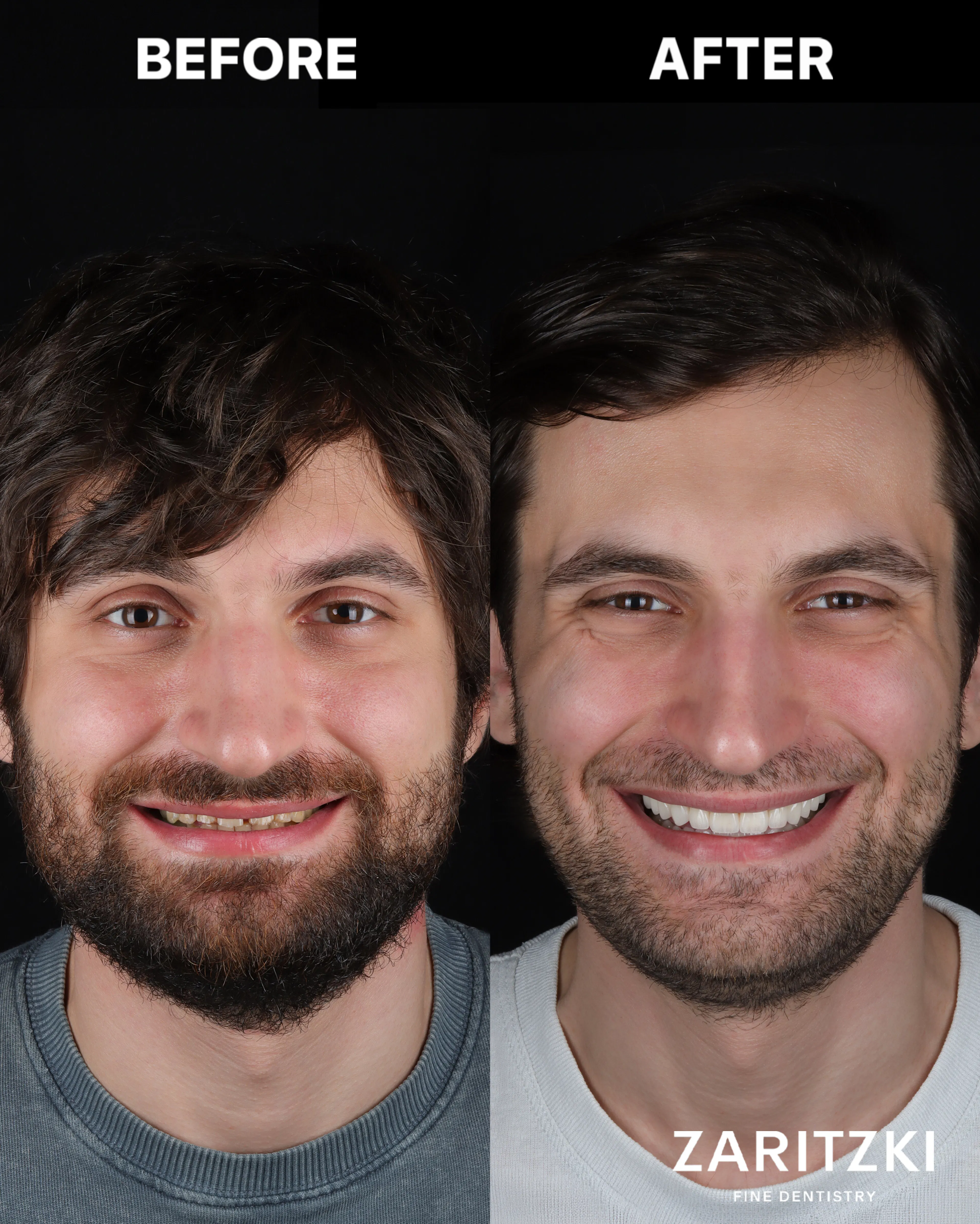 Smile Transformation: Porträt des Patienten vorher und nachher, Zaritzki Fine Dentistry, Berlin